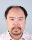 Before Hair Transplant &nbsp;Front